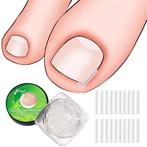 RMISODO 60 Pieces Ingrown Toenail Corrector Strips, Professional Toenail Correction Patches, Curved Toenails Straightening Recover Clips, Thick Paronychia Correction Pedicure Tool for Foot Care